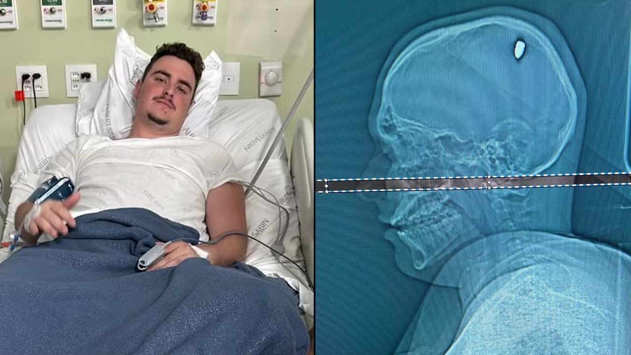 Lad powers through 4-day bender after not realising he'd been shot in the head